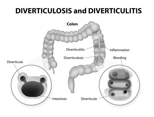 Divertikel Thema Darm